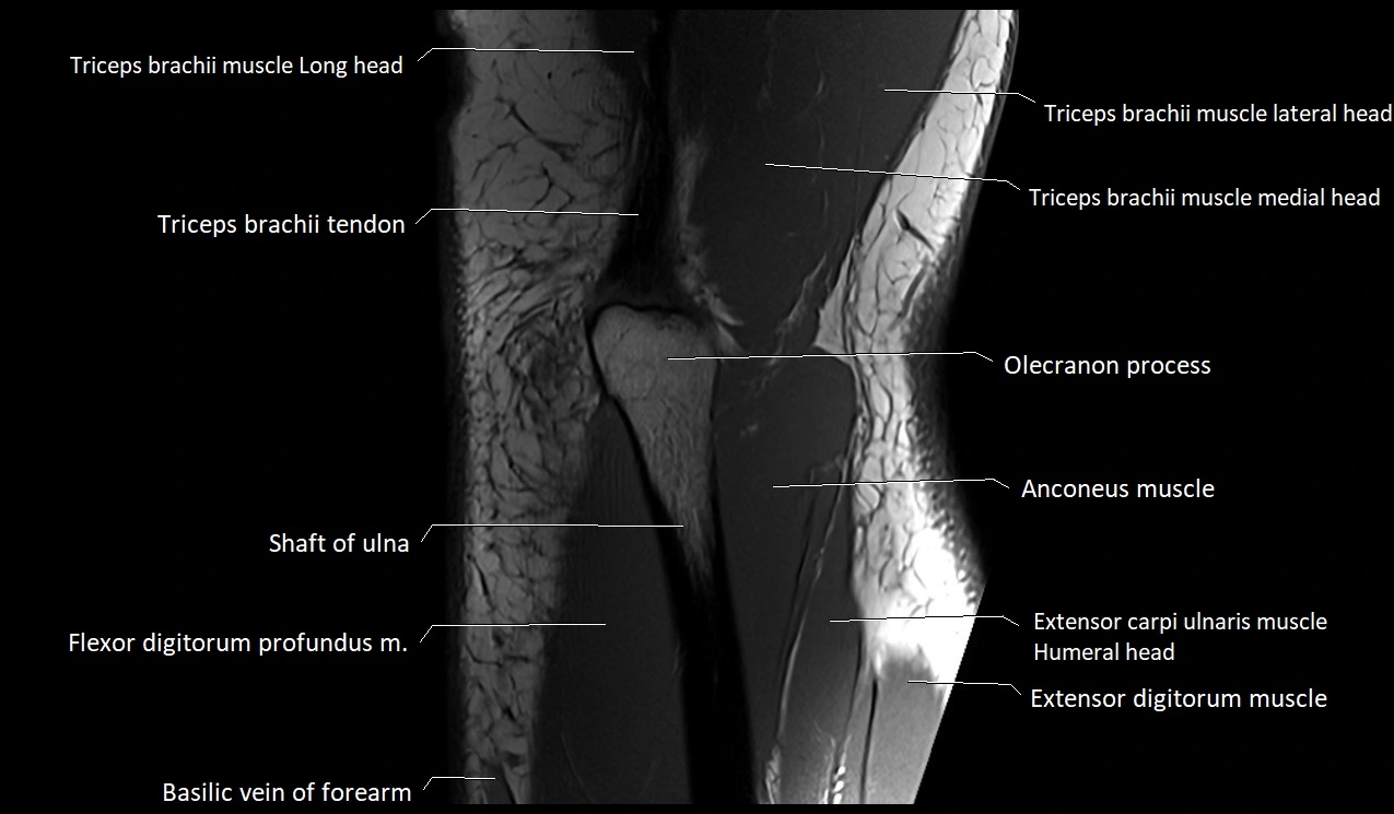 Elbow coronal anatomy image  cross sectional 3T MRI image 28.webp